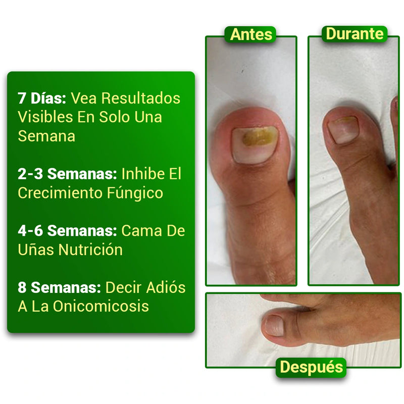 Aceite de Jengibre Antimicótico para Uñas - RenovaUñas [PAGO SOLO AL RECIBIR]