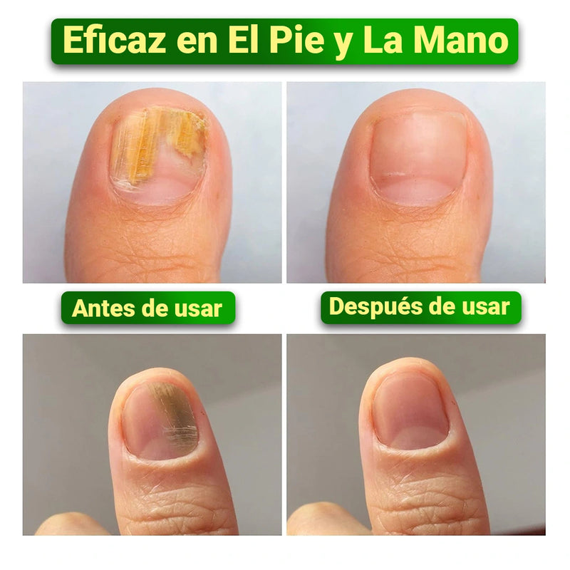 Aceite de Jengibre Antimicótico para Uñas - RenovaUñas [PAGO SOLO AL RECIBIR]